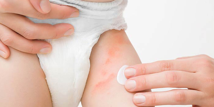 عرق سوز شدن نوزاد