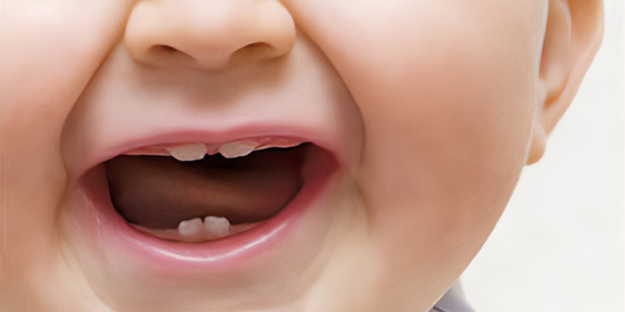 لثه شور نوزاد 