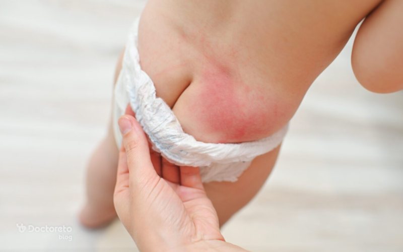 آشنایی با نحوه استفاده از پماد سوختگی پای نوزاد