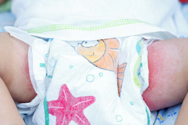 علت سوختگی پای نوزاد