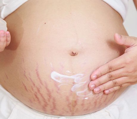 درمان ترک روی شکم در حین و بعد بارداری