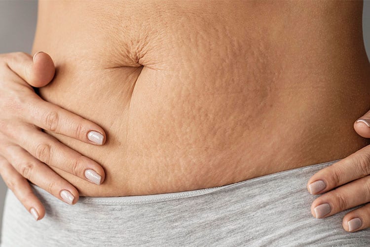 درمان ترک روی شکم در حین و بعد بارداری
